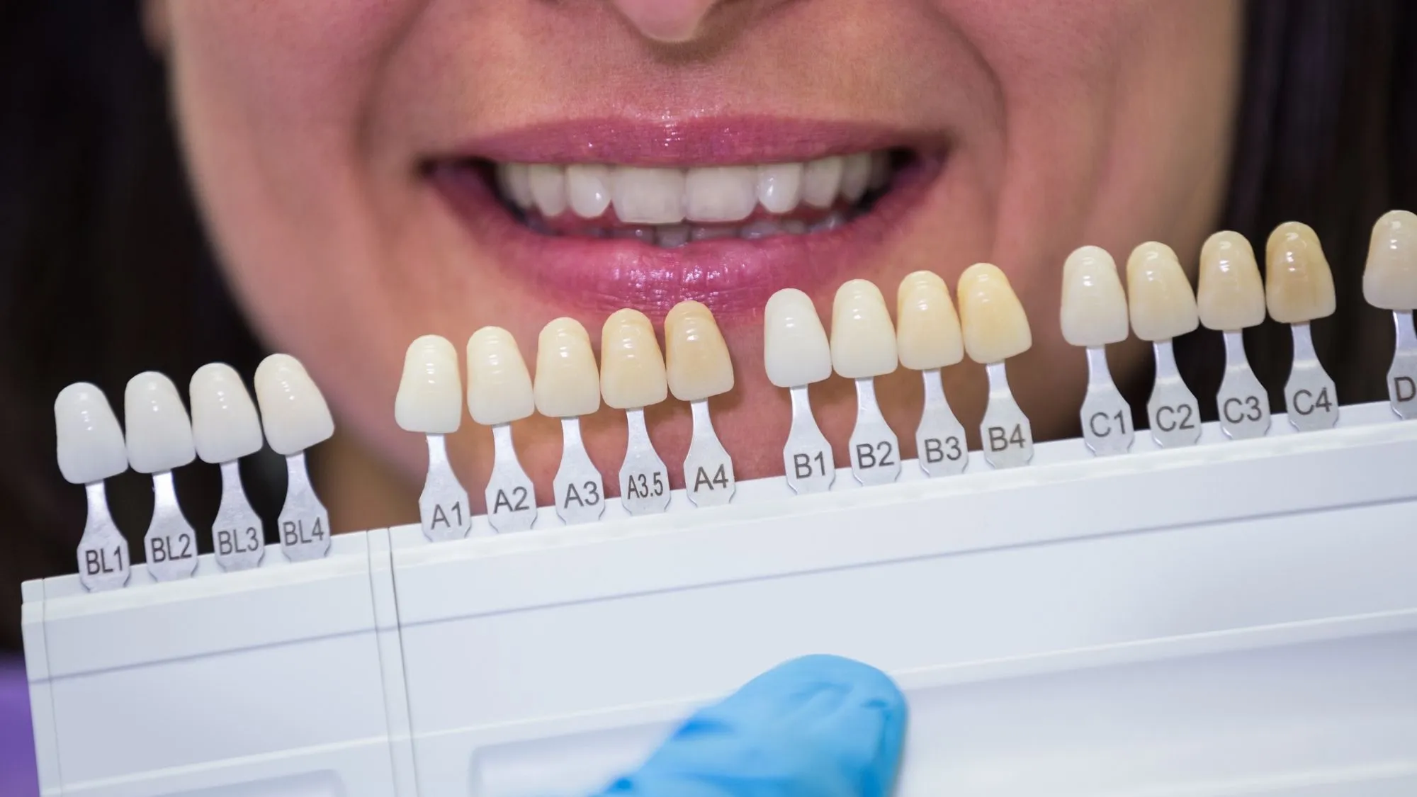 Is A1 Tooth Shade too White 