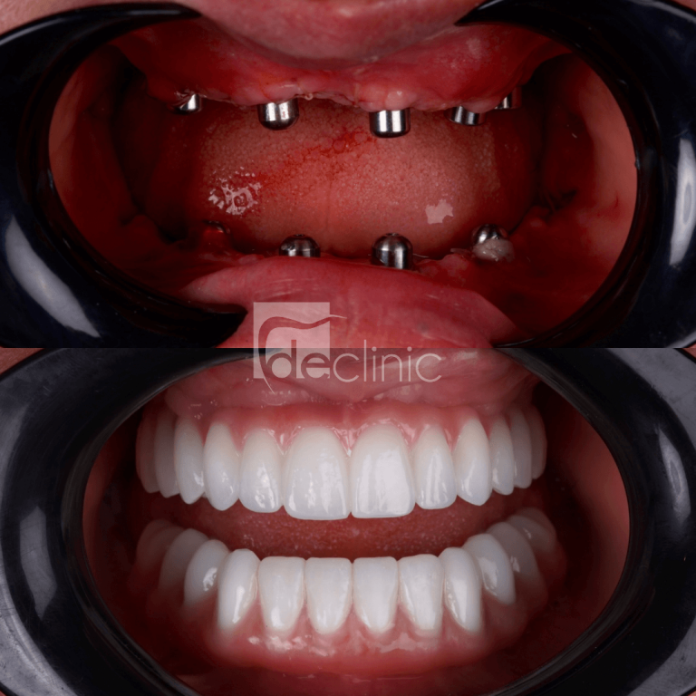 implant-operation  
