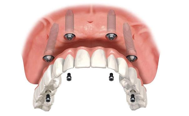 implant-operation  